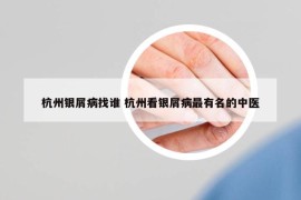 杭州银屑病找谁 杭州看银屑病最有名的中医