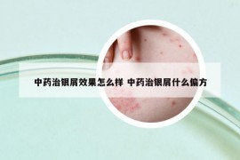 中药治银屑效果怎么样 中药治银屑什么偏方