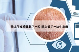 脸上牛皮癣又长了一粒 脸上长了一块牛皮癣