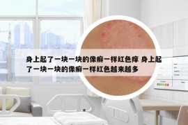 身上起了一块一块的像癣一样红色痒 身上起了一块一块的像癣一样红色越来越多