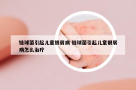 链球菌引起儿童银屑病 链球菌引起儿童银屑病怎么治疗