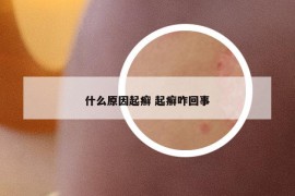 什么原因起癣 起癣咋回事