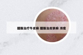醋酸治疗牛皮癣 醋酸治皮肤癣 浓度