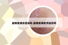 副银屑病会感染吗 副银屑病有传染性吗