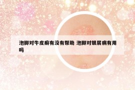 泡脚对牛皮癣有没有帮助 泡脚对银屑病有用吗