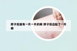 脖子后面有一片一片的癣 脖子后边起了一片癣