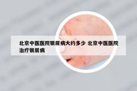 北京中医医院银屑病大约多少 北京中医医院治疗银屑病