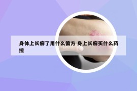 身体上长癣了用什么偏方 身上长癣买什么药擦