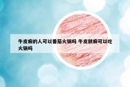 牛皮癣的人可以番茄火锅吗 牛皮肤癣可以吃火锅吗