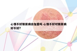 心情不好银屑病会加重吗 心情不好对银屑病好不好?
