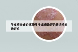牛皮癣治好的情况吗 牛皮癣治好的情况吗能治好吗