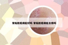 掌跖脓疱病能好吗 掌跖脓疱病能去根吗