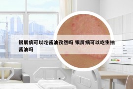 银屑病可以吃酱油孜然吗 银屑病可以吃生抽酱油吗
