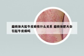 扁桃体大能牛皮癣有什么关系 扁桃体肥大会引起牛皮癣吗