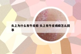 头上为什么有牛皮癣 头上有牛皮病癣怎么回事
