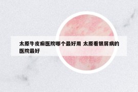 太原牛皮癣医院哪个最好用 太原看银屑病的医院最好
