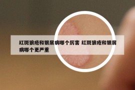 红斑狼疮和银屑病哪个厉害 红斑狼疮和银屑病哪个更严重
