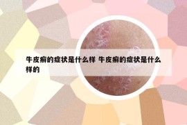 牛皮癣的症状是什么样 牛皮癣的症状是什么样的