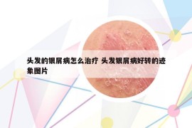 头发的银屑病怎么治疗 头发银屑病好转的迹象图片