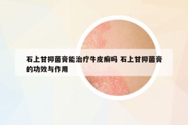 石上甘抑菌膏能治疗牛皮癣吗 石上甘抑菌膏的功效与作用