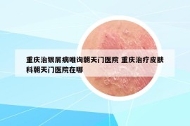 重庆治银屑病唯询朝天门医院 重庆治疗皮肤科朝天门医院在哪