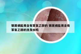 银屑病能用含有苯氧乙醇的 银屑病能用含有苯氧乙醇的洗发水吗