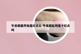 牛皮癣最开始是红点么 牛皮癣起初是个红点吗