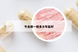 牛皮癣一般多少年能好