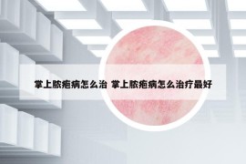 掌上脓疱病怎么治 掌上脓疱病怎么治疗最好