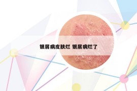 银屑病皮肤烂 银屑病烂了