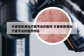 长春银屑病治疗最专业的医院 长春银屑病治疗最专业的医院排名
