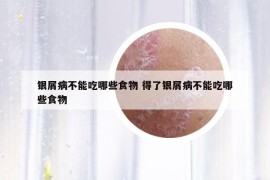 银屑病不能吃哪些食物 得了银屑病不能吃哪些食物