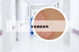 牛皮癣蜕皮吗
