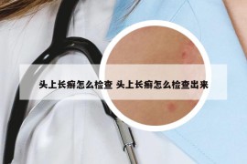 头上长癣怎么检查 头上长癣怎么检查出来