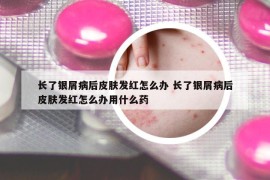 长了银屑病后皮肤发红怎么办 长了银屑病后皮肤发红怎么办用什么药