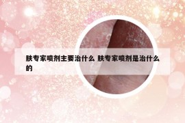 肤专家喷剂主要治什么 肤专家喷剂是治什么的