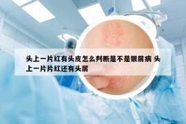 头上一片红有头皮怎么判断是不是银屑病 头上一片片红还有头屑