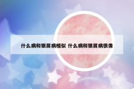 什么病和银屑病相似 什么病和银屑病很像