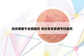 安庆哪里牛皮癣医院 安庆有皮肤病专科医院