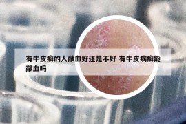 有牛皮癣的人献血好还是不好 有牛皮病癣能献血吗