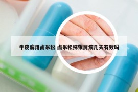 牛皮癣用卤米松 卤米松抹银屑病几天有效吗