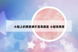 小腿上的银屑病不容易康复 小腿有银屑