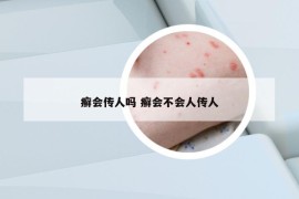 癣会传人吗 癣会不会人传人