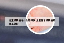 儿童银屑病吃什么好得快 儿童得了银屑病用什么药好