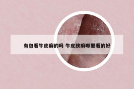 有包看牛皮癣的吗 牛皮肤癣哪里看的好