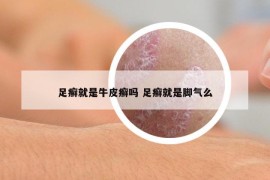 足癣就是牛皮癣吗 足癣就是脚气么