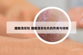 醋酸泼尼松 醋酸泼尼松片的作用与功效