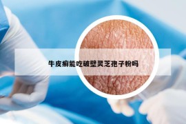 牛皮癣能吃破壁灵芝孢子粉吗