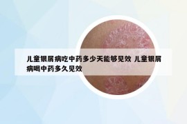 儿童银屑病吃中药多少天能够见效 儿童银屑病喝中药多久见效