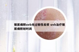 银屑病照uvb光过敏性皮疹 uvb治疗银屑病照射时间